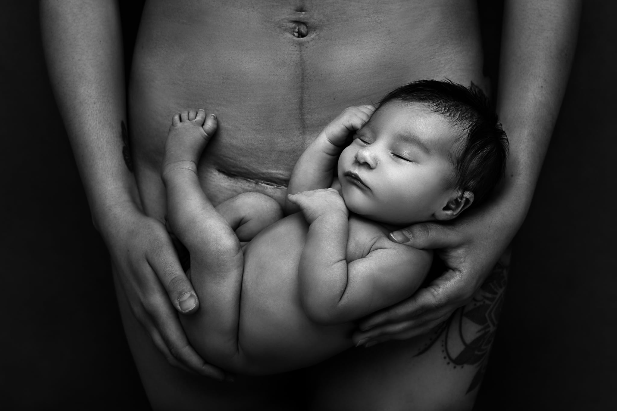 Cesarean birth photo